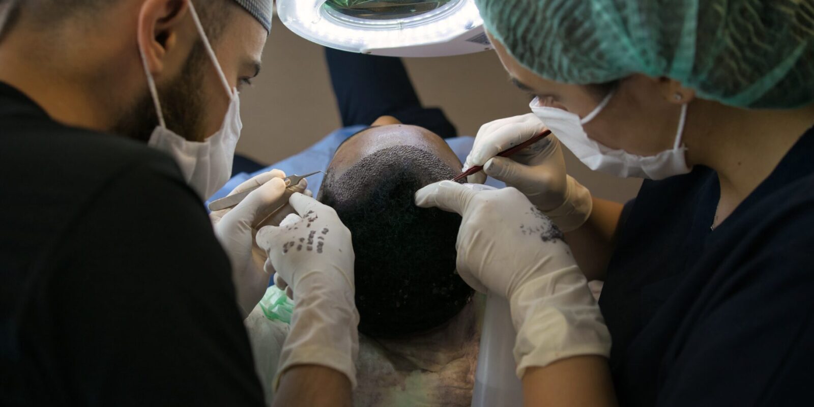 Haartransplantation Methoden