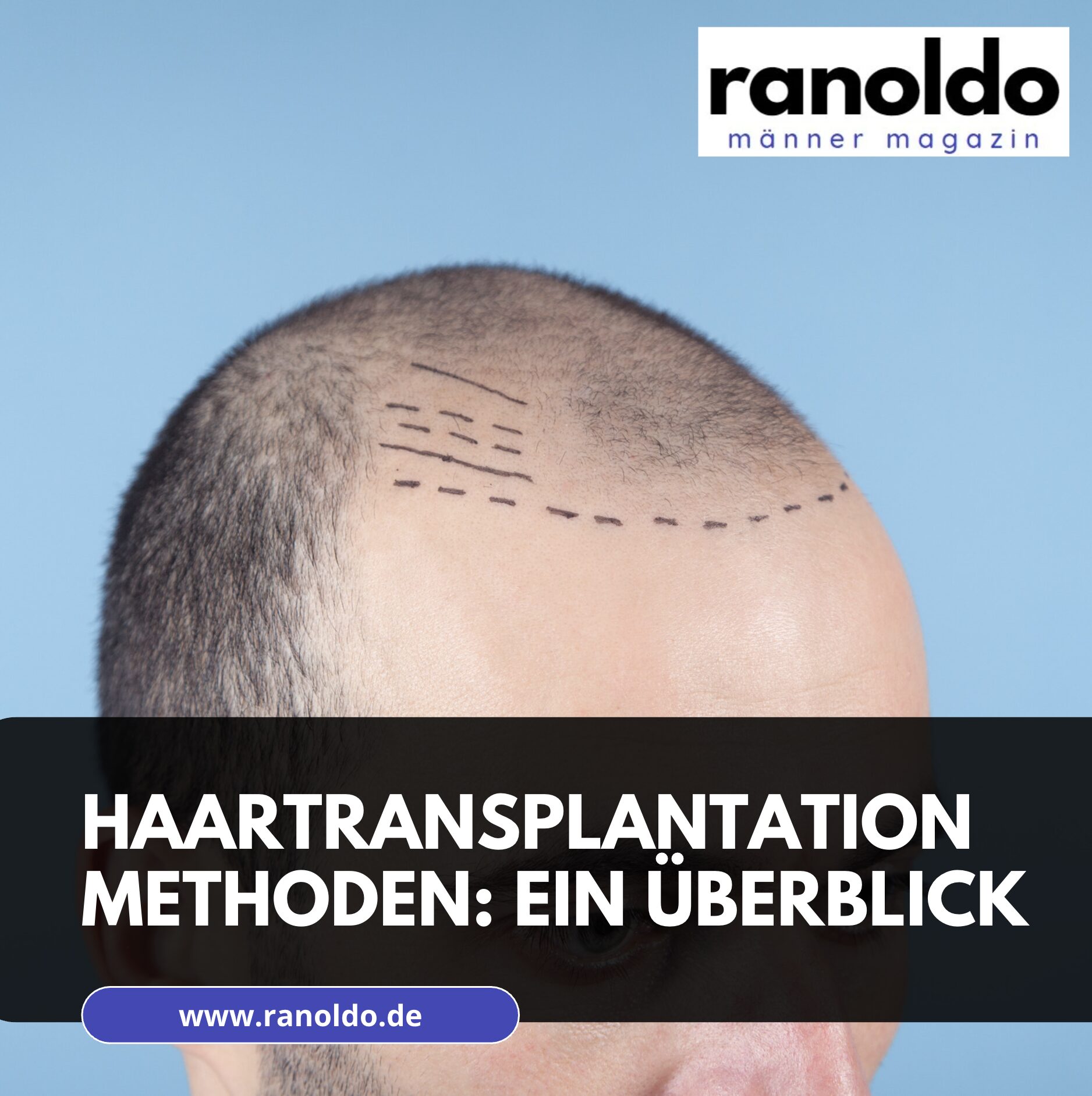 Haartransplantation Methoden: Ein Überblick Haartransplantation Methoden: Ein Überblick